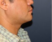 Neck Liposuction and Chin Implant 202 - after