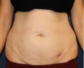 Tummy Tuck 213 - before