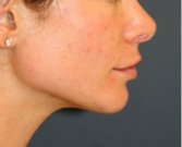 Chin Implant 201 - after