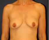Breast Augmentation Lift 55 - before