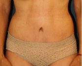 Tummy-Tuck 214 - after