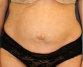 Tummy Tuck 215 - before