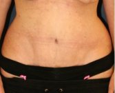 Tummy Tuck 215 - after