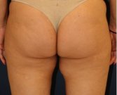 Liposuction Inner Thighs 204 - before