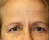 Blepharoplasty Under Browlift 101 - before