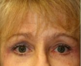 Blepharoplasty Under Browlift 101 - after