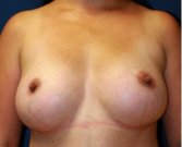 Breast Augmentation 137 - after