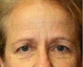 Browlift case 101 - before