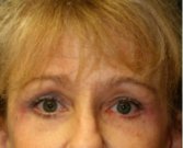 Browlift case 101 - after