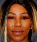 Rhinoplasty 202 - after