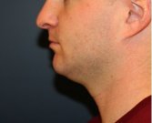 Necklift and Chin Implant 203 - before