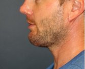 Necklift and Chin Implant 203 - after
