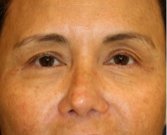 Blepharoplasty Upper Eyelids 102 - before