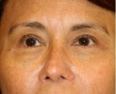 Blepharoplasty Upper Eyelids 102 - after
