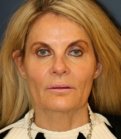 Facelift 100 - before