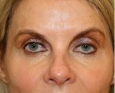 Blepharoplasty Upper Eyelids 103 - before