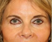 Blepharoplasty Upper Eyelids 103 - after