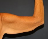 Arm Reduction 206 - before