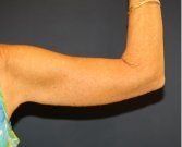 Arm Reduction 206 - after