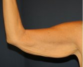Arm Reduction 207 - before