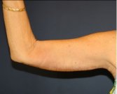 Arm Reduction 207 - after