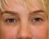 Blepharoplasty Upper Eyelids 104 - before