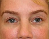 Blepharoplasty Upper Eyelids 104 - after