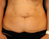Tummy Tuck 216 - before