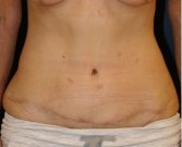 Tummy Tuck 216 - after