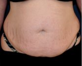 Tummy Tuck 217 - before