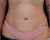 Tummy Tuck 217 - after
