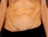 Tummy Tuck 218 - before