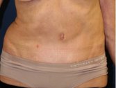 Tummy Tuck 218 - after
