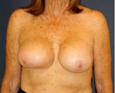 Areola Lift with Breast Implants 56 - before