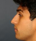 Rhinoplasty 204 - before