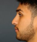 Rhinoplasty 204 - after