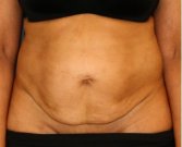 Tummy Tuck 219 - before