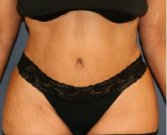 Tummy Tuck 219 - after