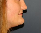 Chin Reduction And Liposuction Beneath The Chin 205 - before