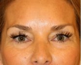 Blepharoplasty 105 - before