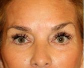 Blepharoplasty 105 - after