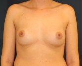 Breast Revision 406 - before