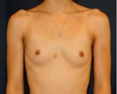 Breast Augmentation 139 - before