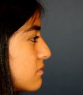 Rhinoplasty 205 - before