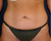Tummy Tuck 220 - before