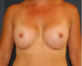 Breast Augmentation 140 - after