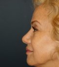 Revision Rhinoplasty 203 - before