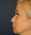 Revision Rhinoplasty 203 - after