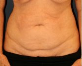 Tummy Tuck 221 - before
