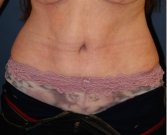 Tummy Tuck 221 - after